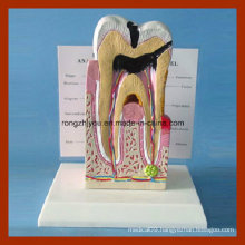 Human Pathological Tooth Anatomical Structure Model